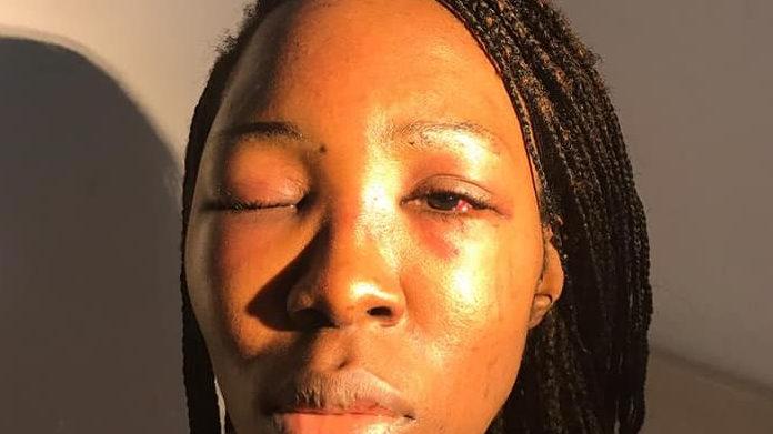 Bari, ragazza del Camerun pubblica le foto su Instagram dopo essere stata picchiata dal suo ex fidanzato