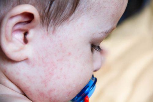 Salute, bambini allergici già all’età di due-tre anni