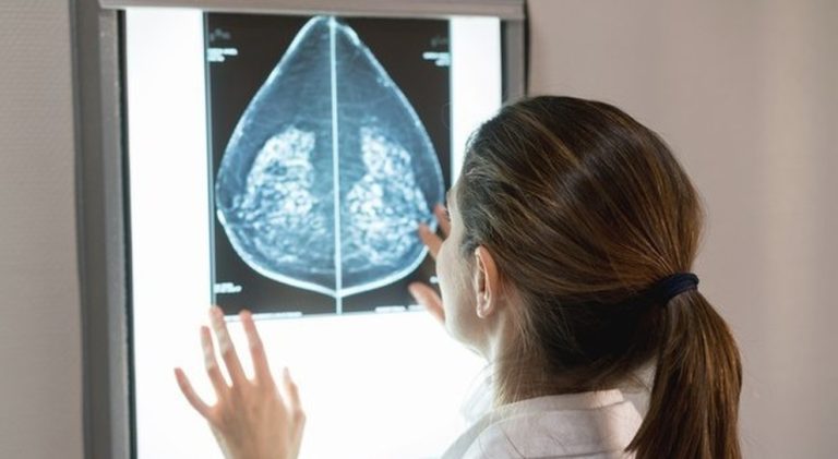 Salute, nuova cura contro il tumore al seno senza la chemioterapia