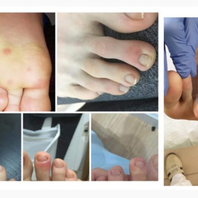 Coronavirus, riscontrate anche lesioni alle dita dei piedi per il Covid