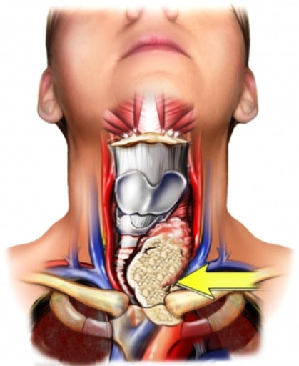 Salute: il tumore alla tiroide si può guarire evitando l’intervento chirurgico