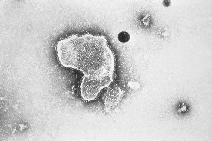 Virus respiratorio sinciziale, parla il professor Burioni: “Purtroppo non abbiamo ancora un vaccino efficace”