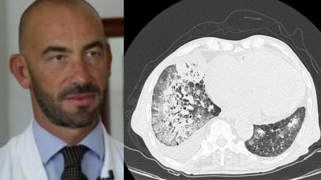 Covid, immagini choc: il professor Bassetti mostra delle radiografie di pazienti non vaccinati