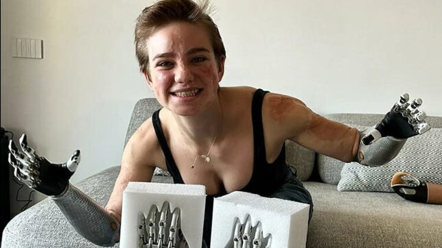 Bebe Vio, ecco le sue nuove mani: “Non vedo l’ora di provarle”